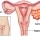 Kista Coklat / Endometriosis